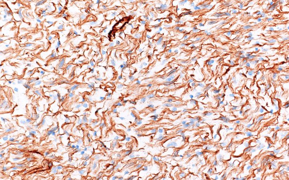 1D1 Neurofibroma, NF1 patient (Case 1) Coll IV 1