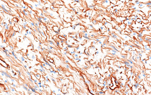 1D2 Neurofibroma, NF1 patient (Case 1) Coll IV 2