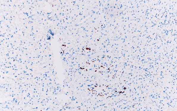 1E Neurofibroma, NF1 patient (Case 1) NF 1