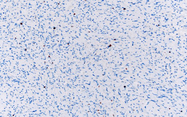 1F Neurofibroma, NF1 patient (Case 1) Ki67