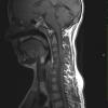 2A1 Neurofibroma (Case 2) T1 1 - Copy