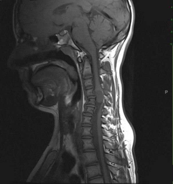 2A1 Neurofibroma (Case 2) T1 1 - Copy