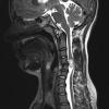 2A2 Neurofibroma (Case 2) T2 1 - Copy