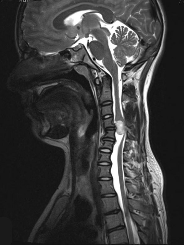 2A2 Neurofibroma (Case 2) T2 1 - Copy