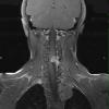 2A3 Neurofibroma (Case 2) T1 W 1 - Copy