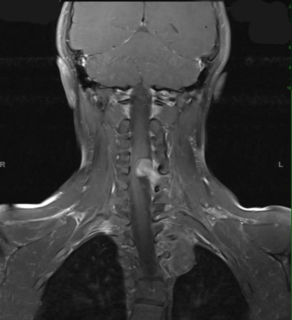 2A3 Neurofibroma (Case 2) T1 W 1 - Copy