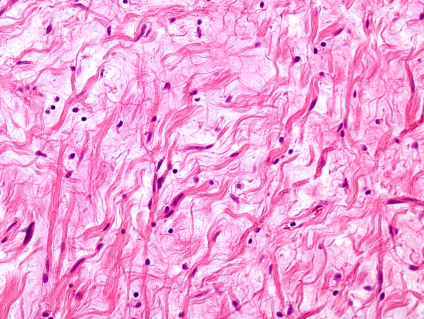 2B3 Neurofibroma (Case 2) H&E 3