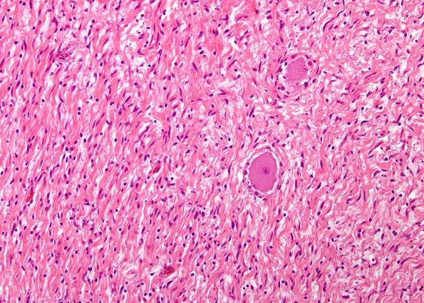 2B4  Neurofibroma (Case 2) H&E 5