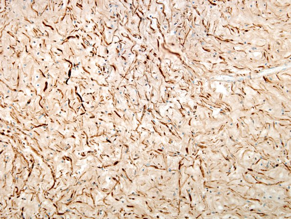 2C1 Neurofibroma (Case 2) S100 2