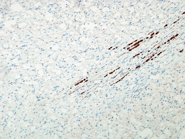 2D1 Neurofibroma (Case 2) NF 4