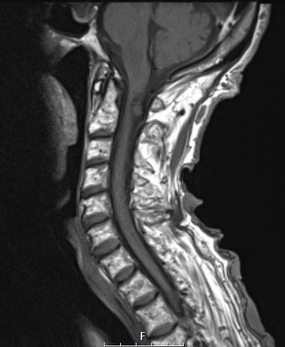 3A2 Neurofibromas NF1 patient (Case 3) T1 2