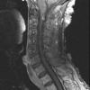 3A3 Neurofibromas NF1 patient (Case 3) T1W 2