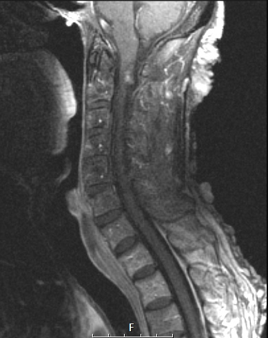 3A3 Neurofibromas NF1 patient (Case 3) T1W 2