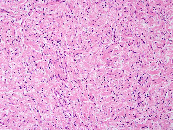 3B2 Neurofibromas NF1 patient (Case 3) H&E 1