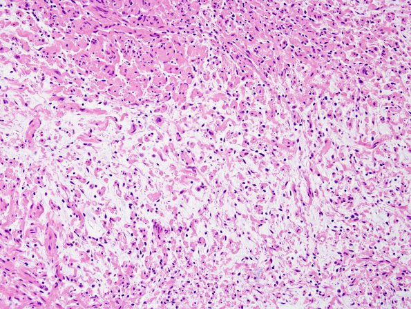 3B3 Neurofibromas NF1 patient (Case 3) H&E 25