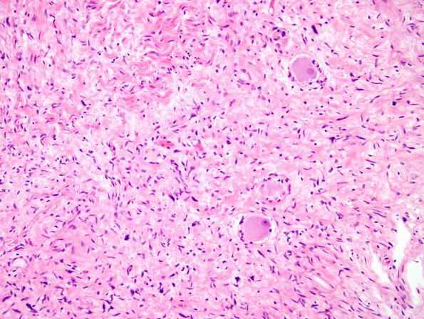 3B4 Neurofibromas NF1 patient (Case 3) H&E 4