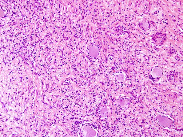 3B5 Neurofibromas NF1 patient (Case 3) H&E 9