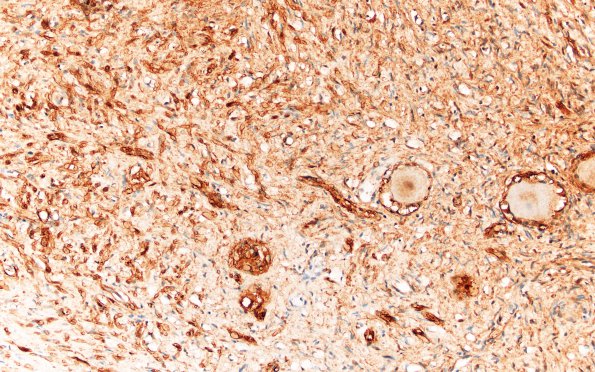 3C1 Neurofibromas NF1 patient (Case 3) S100 20X