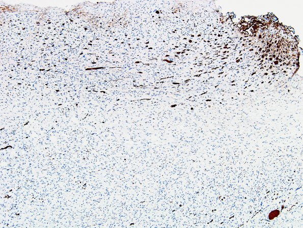 3E1 Neurofibromas NF1 patient (Case 3) NF 4