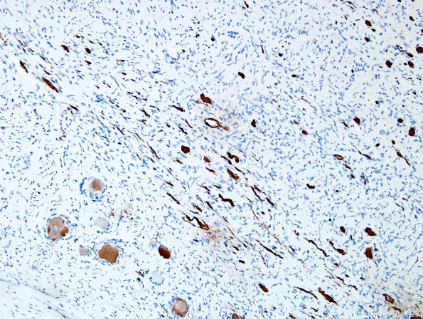 3E2 Neurofibromas NF1 patient (Case 3) S100 5