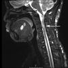 4A1 Neurofibroma, plexiform & Meningeal HP (Case 4) STIR copy