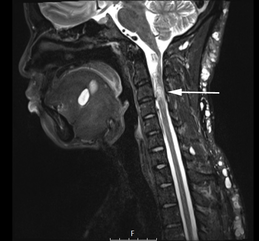 4A1 Neurofibroma, plexiform & Meningeal HP (Case 4) STIR copy