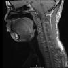 4A2 Neurofibroma, plexiform & Meningeal HP (Case 4) T1noC - Copy