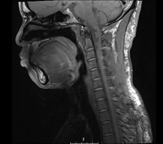 4A2 Neurofibroma, plexiform & Meningeal HP (Case 4) T1noC - Copy