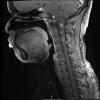 4A3 Neurofibroma, plexiform & Meningeal HP (S10-14884) T1W 2 - Copy