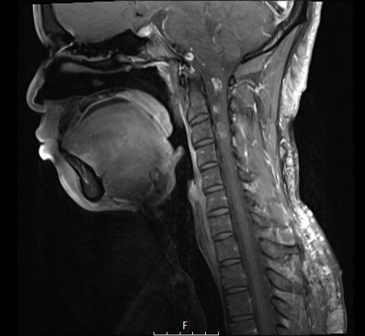 4A3 Neurofibroma, plexiform & Meningeal HP (S10-14884) T1W 2 - Copy