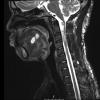 4A4 Neurofibroma, plexiform & Meningeal HP (Case 4) T2 - Copy