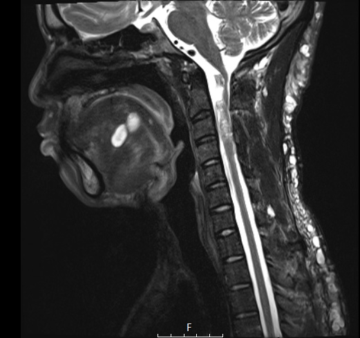 4A4 Neurofibroma, plexiform & Meningeal HP (Case 4) T2 - Copy