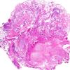 4B1 Neurofibroma, plexiform & Meningeal HP (Case 4) H&E 10.jpg