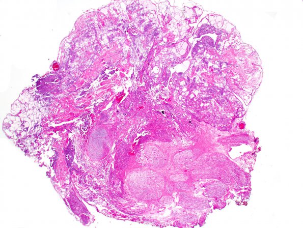 4B1 Neurofibroma, plexiform & Meningeal HP (Case 4) H&E 10.jpg