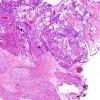 4B2 Neurofibroma, plexiform & Meningeal HP (Case 4) H&E 2