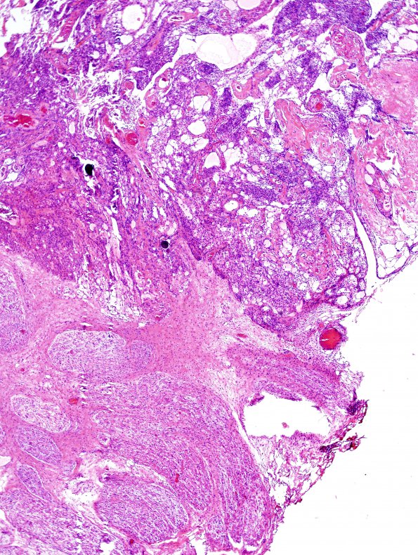 4B2 Neurofibroma, plexiform & Meningeal HP (Case 4) H&E 2