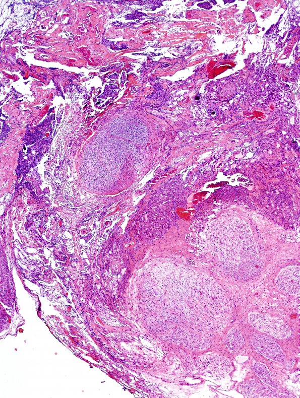 4B3 Neurofibroma, plexiform & Meningeal HP (Case 4) H&E 6