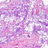 4B4 Neurofibroma, plexiform & Meningeal HP (Case 4) H&E 7