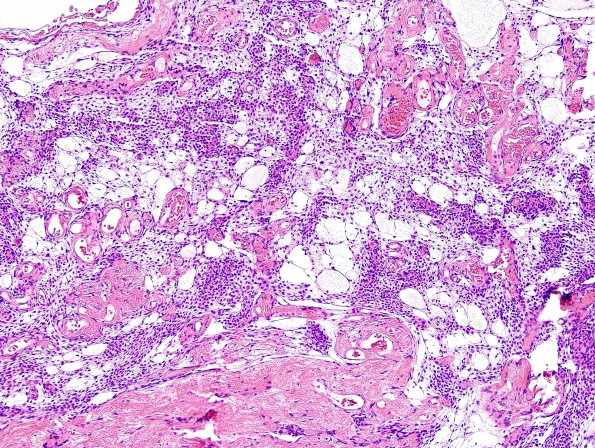 4B4 Neurofibroma, plexiform & Meningeal HP (Case 4) H&E 7