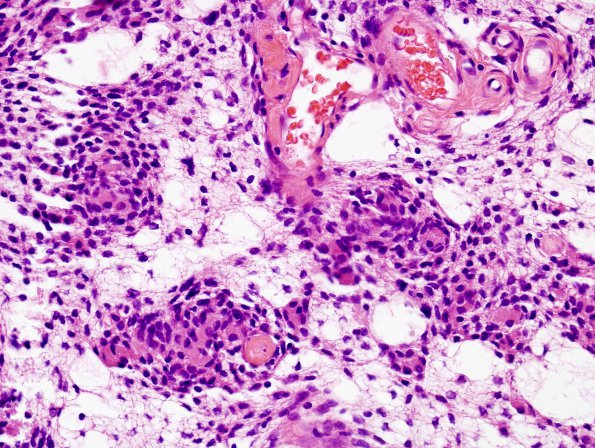 4B5 Neurofibroma, plexiform & Meningeal HP (Case 4) H&E 9