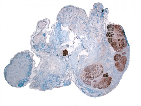 4C1 Neurofibroma, plexiform & Meningeal HP (Case 4) S-100 1.jpg