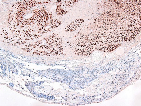 4C2 Neurofibroma, plexiform & Meningeal HP (Case 4) S-100 2.jpg