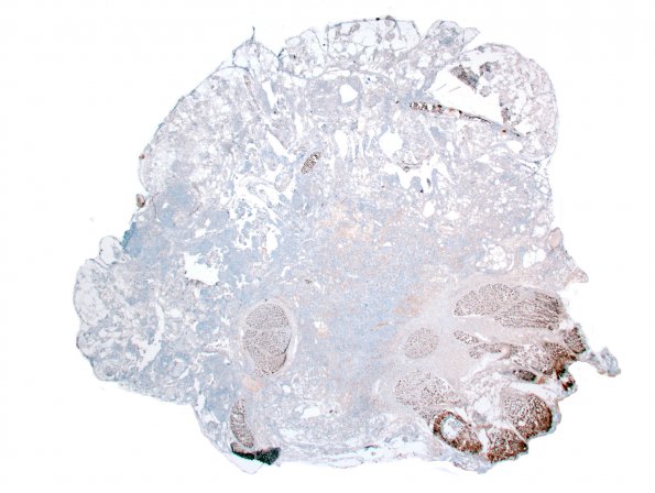 4D1 Neurofibroma, plexiform & Meningeal HP (Case 4) NF 4.jpg