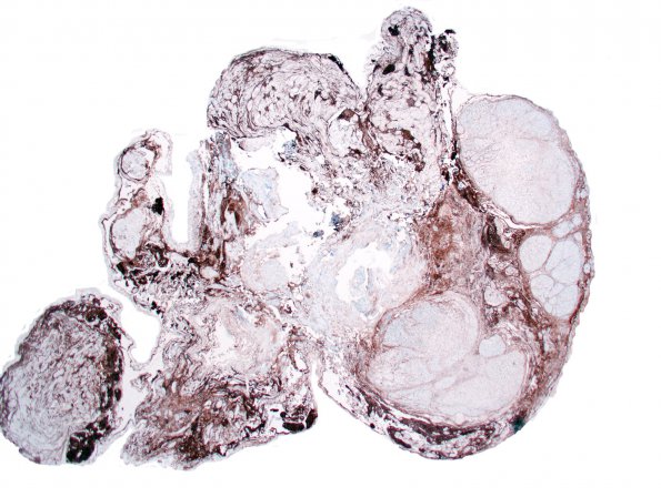 4E1 Neurofibroma, plexiform & Meningeal HP (Case 4) EMA 1.jpg