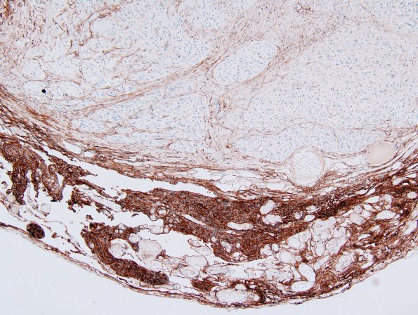 4E2 Neurofibroma, plexiform & Meningeal HP (Case 4) EMA 2.jpg