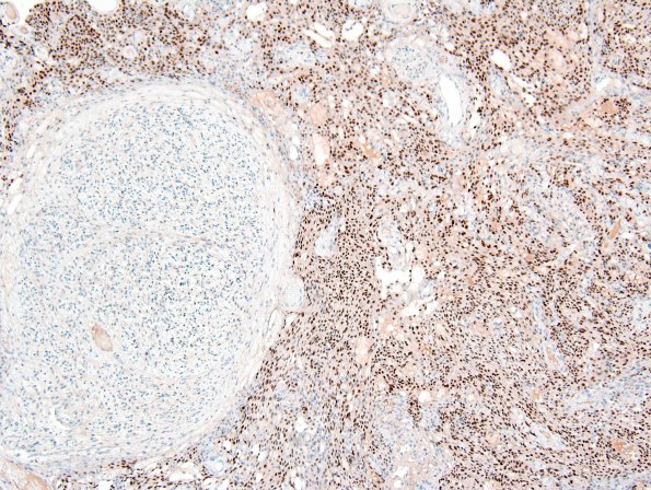 4F2 Neurofibroma, plexiform & Meningeal HP (Case 4) PR 2.jpg