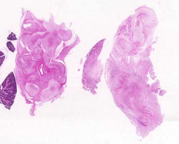 5A1 Neurofibroma, plexiform (Case 5) H&E whole mount