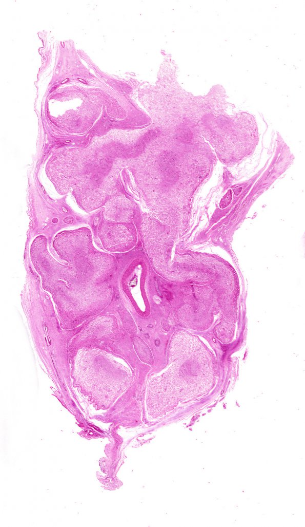 5A2 Neurofibroma, Plexiform (Case 5) NF