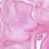 5A3 Neurofibroma, plexiform (Case 5) H&E1