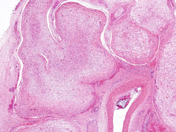 5A3 Neurofibroma, plexiform (Case 5) H&E1